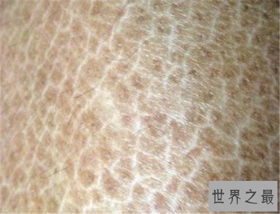 世界最奇怪的病，这种病太恐怖了简直头皮发麻！