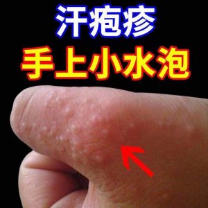 ​手指脚缝皮下出水泡 脚趾缝和脚底生水泡又痒,这该怎么办