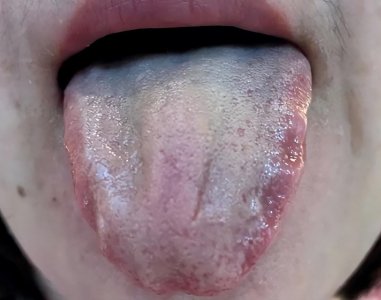​痰瘀互结？送你一剂双合汤，既能化痰，又可化瘀