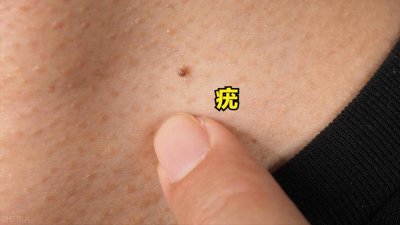 ​警惕！这些小肉揪其实是“疣”，别跟痣还在傻傻分不清了