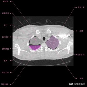 ​肺部CT高清解剖图谱，附带详细标注